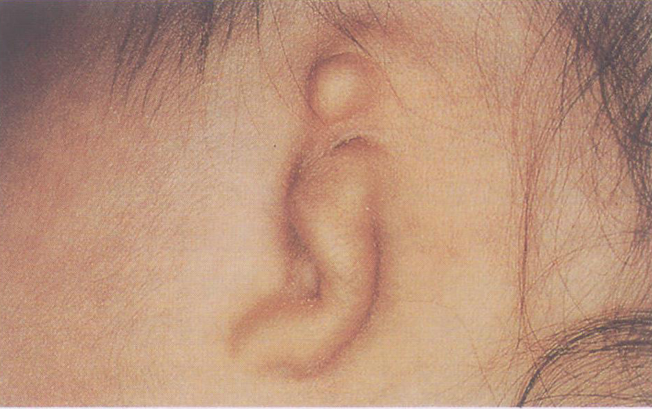 图1.5 小耳征